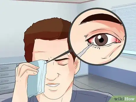 Image titled Remove a Speck From Your Eye Step 10