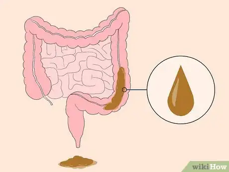 Image titled Know If You Have Worms Step 10