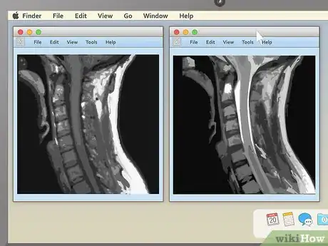 Image titled Read an MRI Step 7