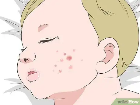 Image titled Get Rid of Baby Acne Step 7