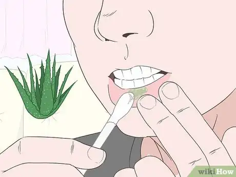 Image titled Treat Cold Sores Inside Your Mouth Step 5