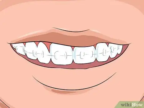 Image titled Choose the Color of Your Braces Step 12