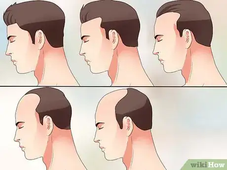 Image titled Measure Hair Loss Step 1