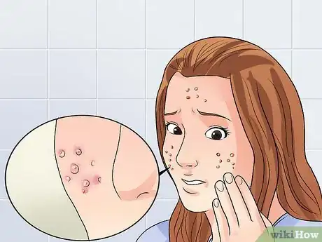 Image titled Get Rid of Acne if You Have Fair Skin Step 1