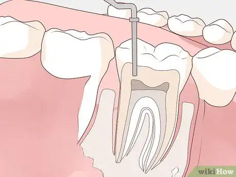 Image titled Get Rid of a Gum Boil Step 3