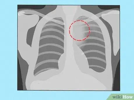 Image titled Know if a Chest X Ray Film Is Rotated Step 11