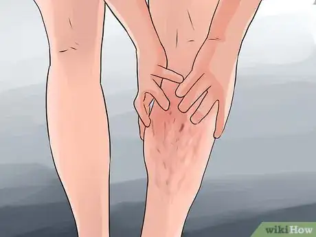 Image titled Prevent Varicose Veins Step 13