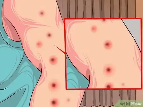 Image titled Perform Melanoma Skin Checks Step 10