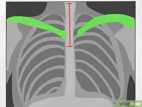 Image titled Know if a Chest X Ray Film Is Rotated Step 2