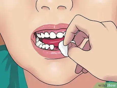 Image titled Stop the Bleeding After You Pull out a Loose Tooth Step 3