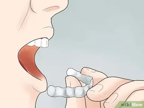 Image titled Clean Invisalign Step 11