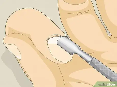 Image titled Stop Biting Your Nails Step 3