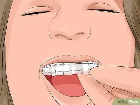 Image titled Prepare for Getting Braces Removed Step 9