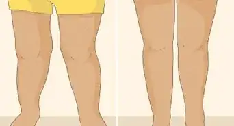 Fix Knock Knees