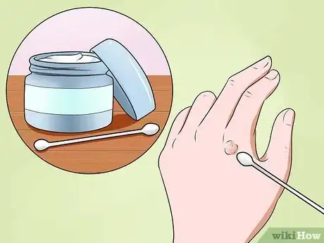 Image titled Get Rid of Warts on Hands Step 4