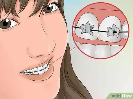 Image titled Make Braces Look Less Noticeable Step 7