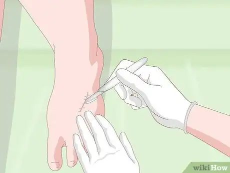 Image titled Get Rid of Scars Step 10