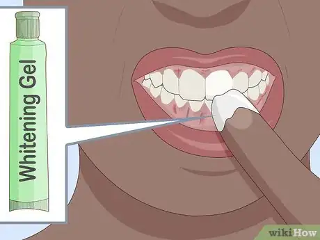 Image titled Protect Gums During Teeth Whitening Step 11