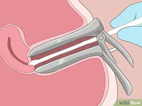 Image titled Do a Pap Smear Step 9