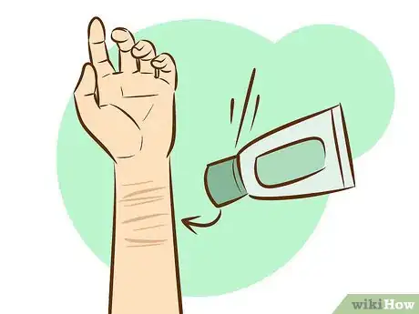 Image titled Get Rid of Self Harm Scars Step 17