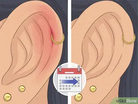 Image titled Is It Safe to Pierce Your Own Cartilage Step 23