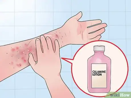 Image titled Get Rid of Stress Hives Step 10