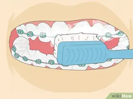 Image titled Brush Your Teeth With Braces On Step 15