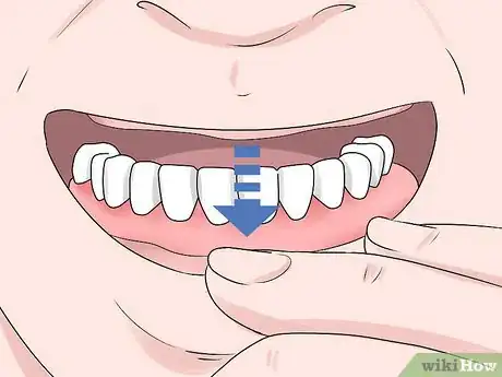 Image titled Keep Bottom Dentures in Place Step 9