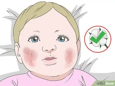 Image titled Get Rid of Baby Acne Step 8