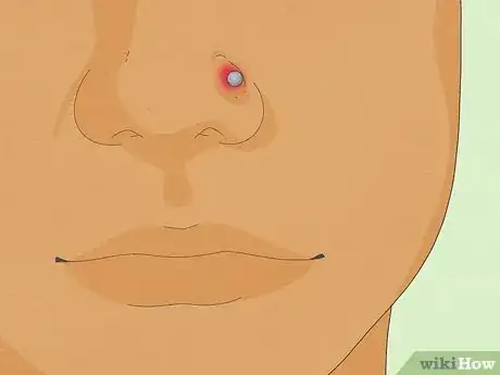 Image titled Treat an Infected Nose Piercing Step 12