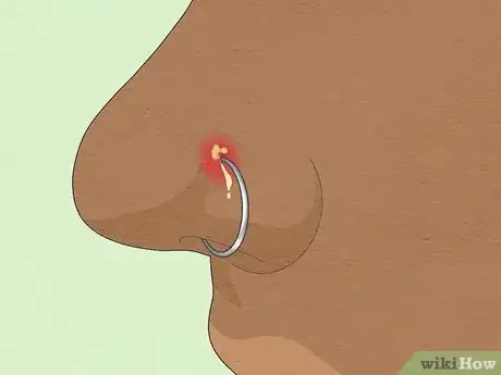 Image titled Treat an Infected Nose Piercing Step 14
