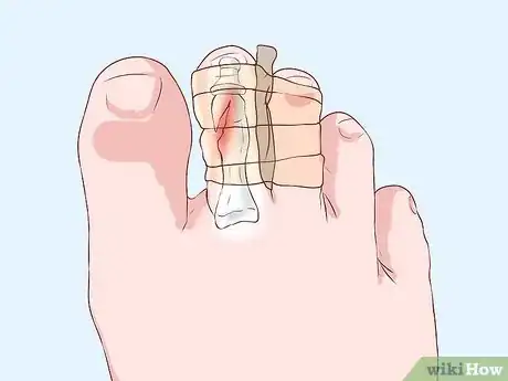 Image titled Bandage Fingers or Toes Step 20