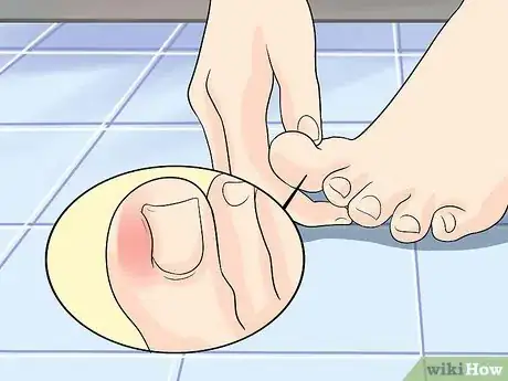 Image titled Heal an Ingrown Toenail Step 10