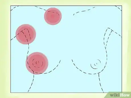 Image titled Know if You Have Breast Cancer Step 9