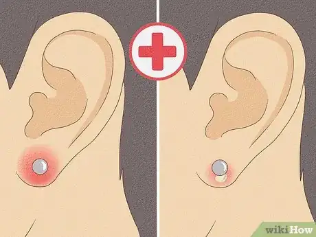 Image titled Treat Infected Piercings Step 1