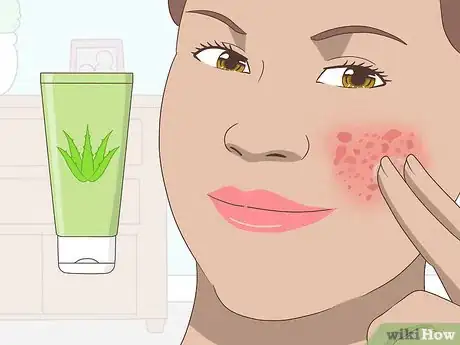 Image titled Use Aloe Vera Gel on Your Face Step 8