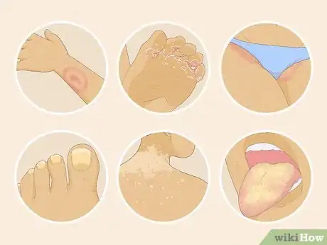 Image titled Treat Fungal Rash Step 1