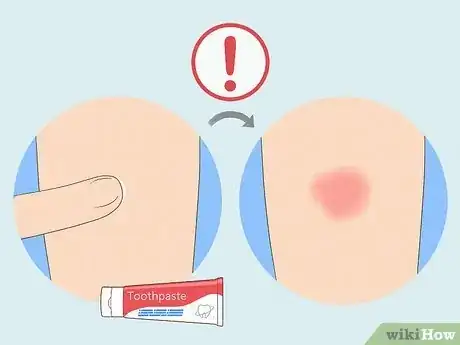 Image titled Get Rid of Bruises with Toothpaste Step 2