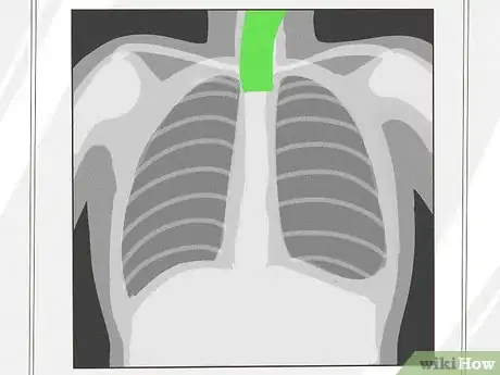 Image titled Know if a Chest X Ray Film Is Rotated Step 4