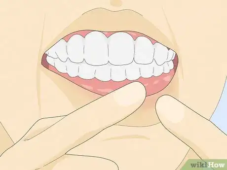 Image titled Fix a Loose Tooth Step 5