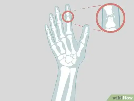 Image titled Determine if a Finger Is Broken Step 16