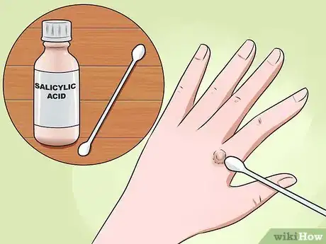 Image titled Get Rid of Warts on Hands Step 2