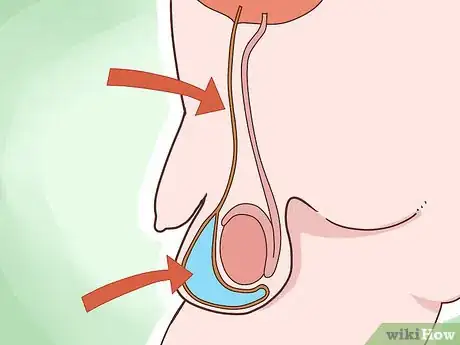 Image titled Know if You Have Hydrocele Step 12