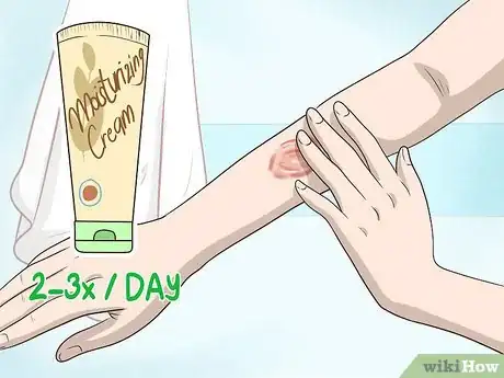 Image titled Get Rid of Burn Scars Step 1