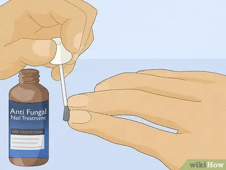 Image titled Get Rid of White Spots on Your Nails Step 15