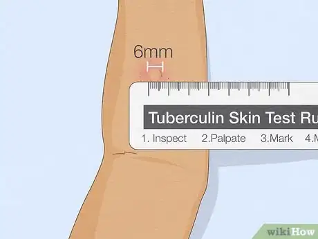 Image titled Properly Place a TB Skin Test Step 15