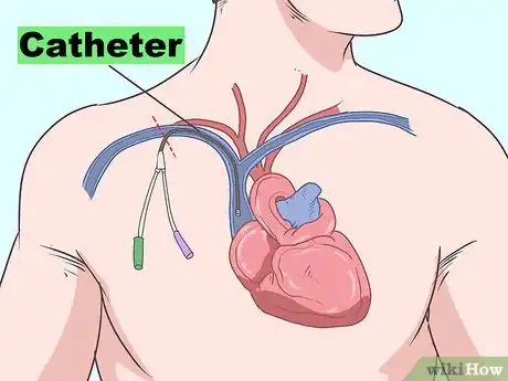 Image titled Treat Myocarditis Step 4