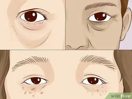 Image titled Improve Under Eye Skin Step 17.jpeg