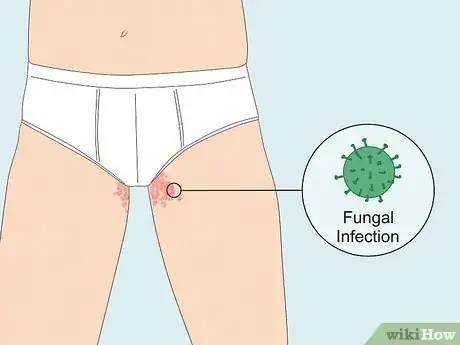 Image titled Get Rid of a Rash Between Your Legs Step 8