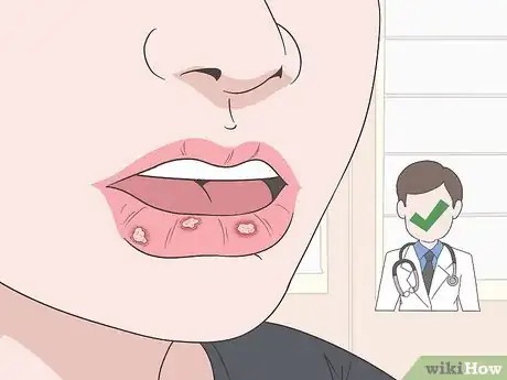 Image titled Reduce Lip Injection Swelling Step 5